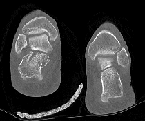 CT scan cross section through the ankles