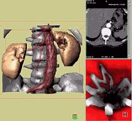 3D CT of aortic stent in place
