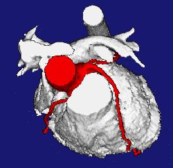 3D reconstruction of the heart showing arteries in red